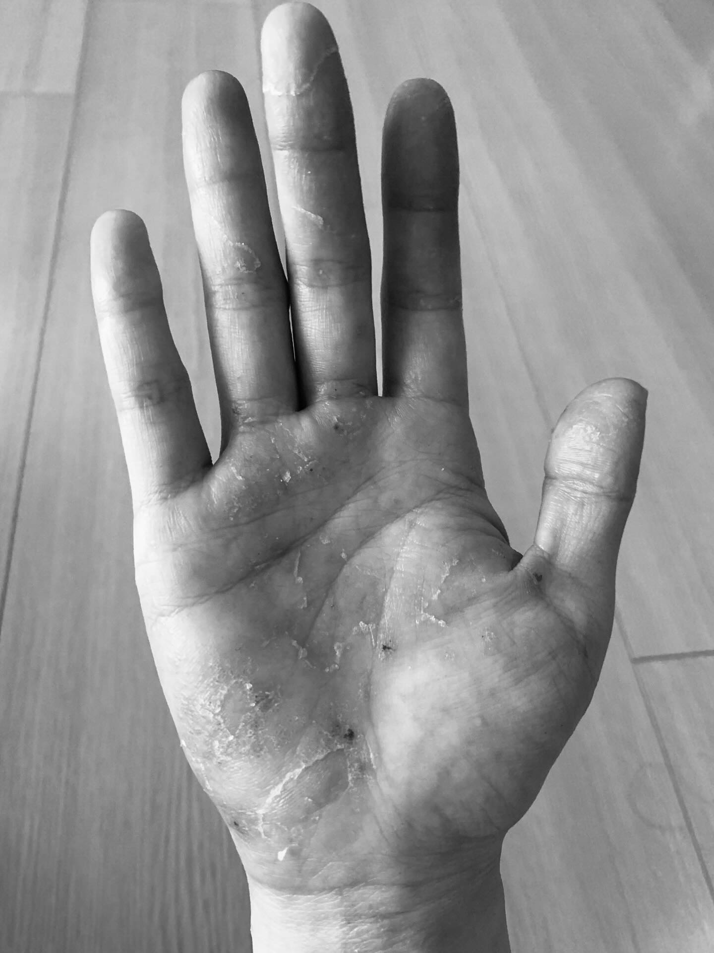 아로마테라피의 놀라운 치유력: 오행아로마 아토피와 한포진 극복 사례