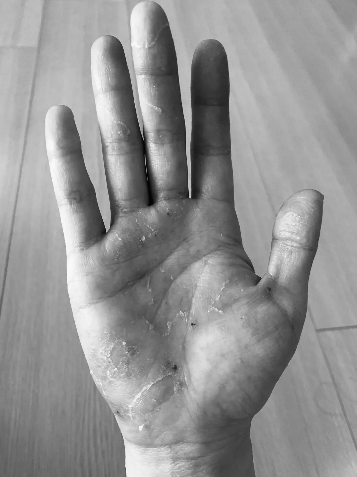 아로마테라피의 놀라운 치유력: 오행아로마 아토피와 한포진 극복 사례